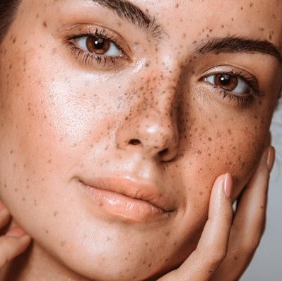 Καφέ κηλίδες: Μια συνήθεια κι ένα skincare λάθος που τις τονίζει | Όχι, δεν είναι το αντηλιακό